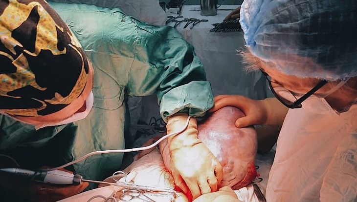 Врачи удалили томичке опухоль размером с новорожденного ребенка